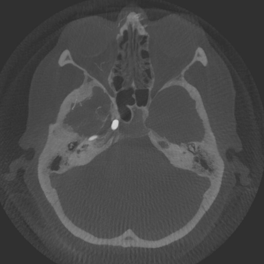 Acute subarachnoid hemorrhage and accessory anterior cerebral artery (Radiopaedia 69231-79010 Axial arterial - MIP 18).jpg
