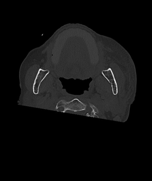 File:Acute traumatic subdural hematoma (Radiopaedia 82921-97257 Axial bone window 114).jpg