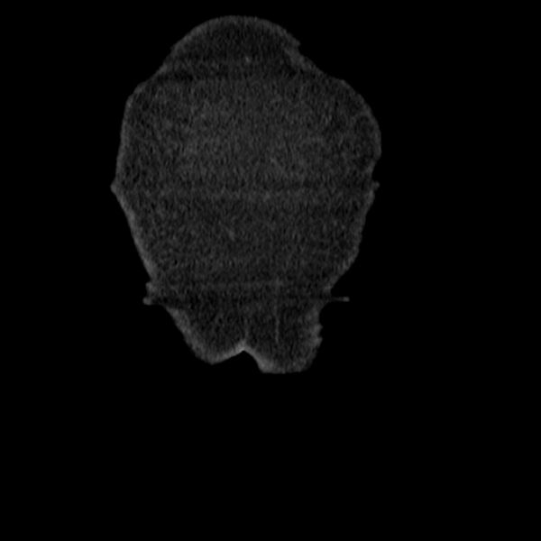 File:Acute tubular necrosis (Radiopaedia 28077-28334 D 6).jpg