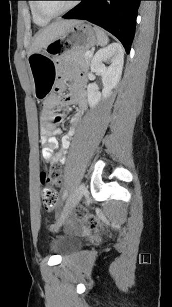 File:Acute uncomplicated appendicitis (Radiopaedia 61374-69304 Sagittal C+ portal venous phase 36).jpg