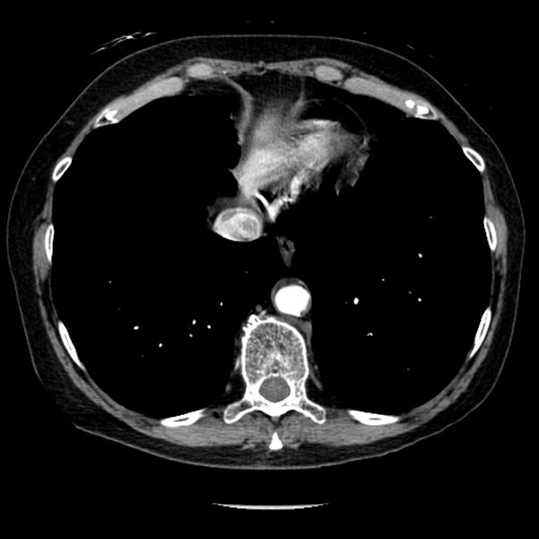 File:Adenocarcinoma of the lung (Radiopaedia 41015-43755 Axial C+ portal venous phase 95).jpg