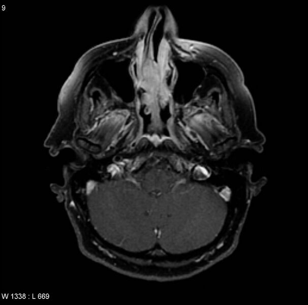 File:Adenoid cystic carcinoma (nasal septum) (Radiopaedia 4547-6668 Axial T1 C+ fat sat 1).jpg