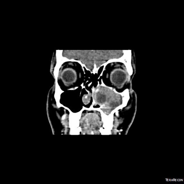 File:Adenoid cystic carcinoma involving paranasal sinus (Radiopaedia 16580-16283 Coronal C+ arterial phase 7).jpeg