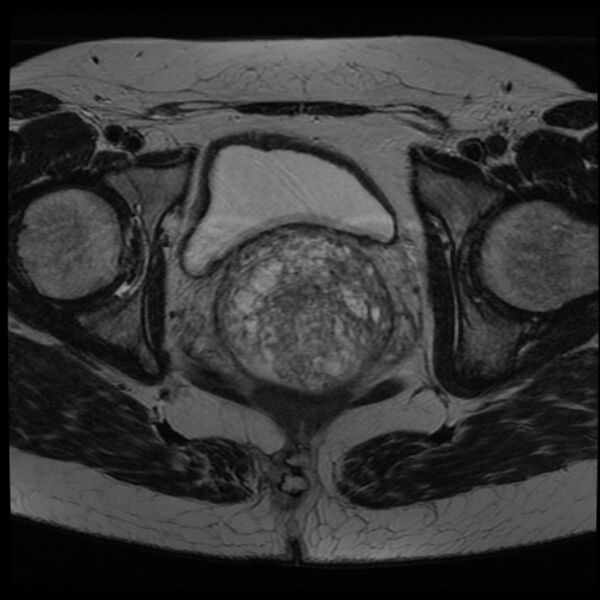 File:Adenoma malignum of the cervix (Radiopaedia 24460-24765 C 18).jpg