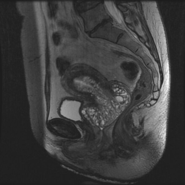 File:Adenoma malignum of the cervix (Radiopaedia 24460-24765 T2 54).jpg