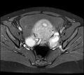 Adenomyosis - ovarian endometriomas (Radiopaedia 67031-76350 Axial T1 C+ fat sat 15).jpg