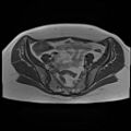 Adenomyosis and endometriotic cysts (Radiopaedia 82300-96367 Axial T1 22).jpg