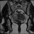 Adenomyosis and endometriotic cysts (Radiopaedia 82300-96367 Coronal T2 16).jpg