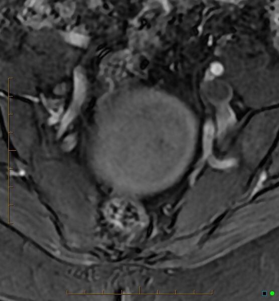File:Adenomyosis uterus with hematometra (Radiopaedia 45779-50011 Axial T1 C+ fat sat 6).jpg