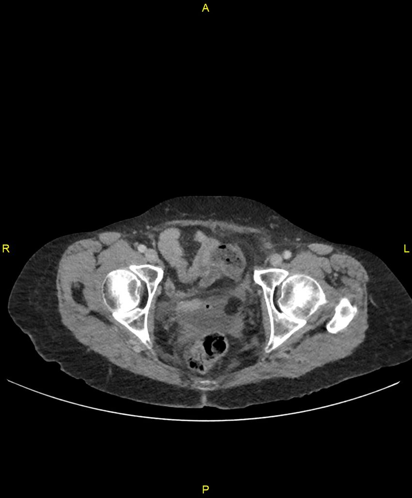 Adhesional small bowel obstruction (Radiopaedia 85402-101024 Axial C+ portal venous phase 269).jpg