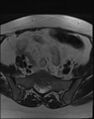 Adnexal multilocular cyst (O-RADS US 3- O-RADS MRI 3) (Radiopaedia 87426-103754 Axial T2 4).jpg