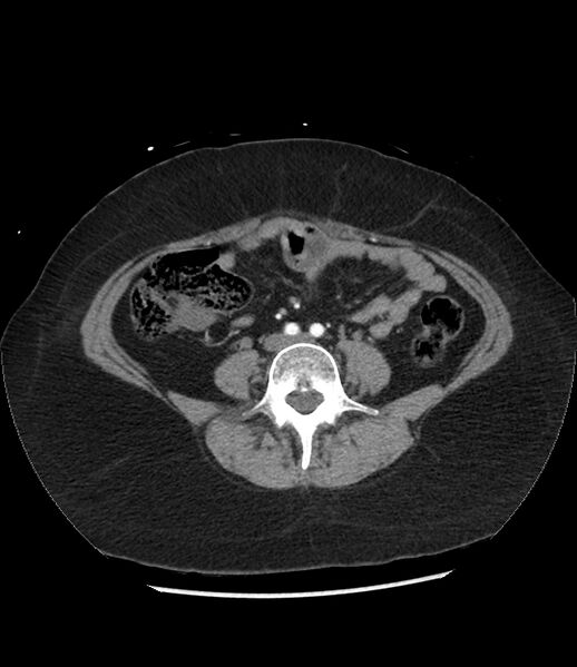 File:Adrenal cortical carcinoma with IVC invasion and thrombosis (Radiopaedia 34307-35597 Axial C+ arterial phase 55).jpg