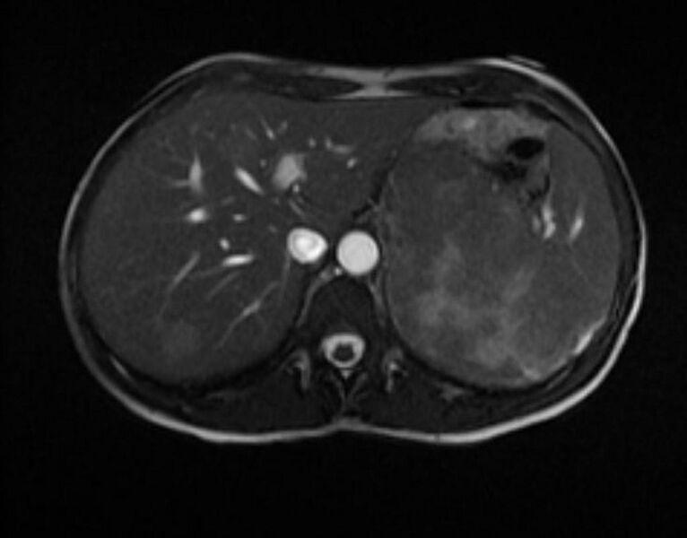 File:Adrenocortical carcinoma (Radiopaedia 11176-11541 Axial 3).jpg