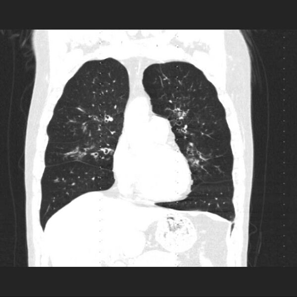 File:Allergic bronchopulmonary aspergillosis (Radiopaedia 21386-21320 Coronal lung window 6).jpg