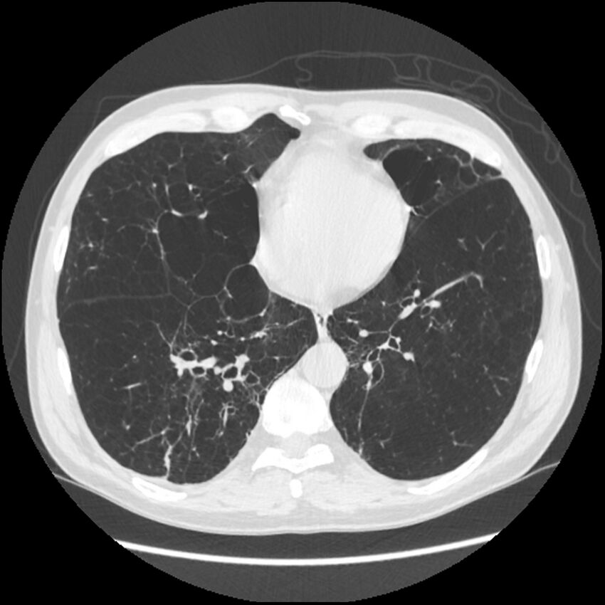 Alpha-1-antitrypsin deficiency (Radiopaedia 40993-43722 Axial lung window 161).jpg