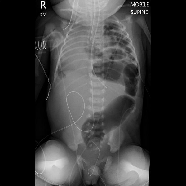 File:Anal atresia and congenital diaphragmatic hernia (Radiopaedia 27462).jpg
