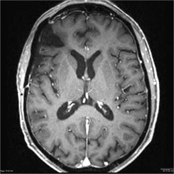 File:Anaplastic meningioma with recurrence (Radiopaedia 34452-35788 Axial T1 C+ 79).jpg