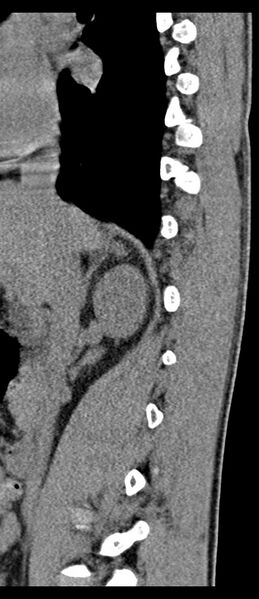 File:Aneurysmal bone cyst T11 (Radiopaedia 29294-29721 E 59).jpg