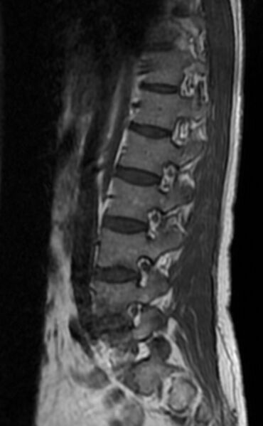 File:Ankylosing spondylitis - Andersson lesion (Radiopaedia 81878-95838 Sagittal T1 4).jpg