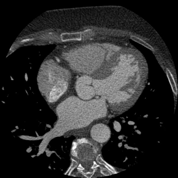 File:Anomalous origin of left circumflex artery from right coronary sinus (Radiopaedia 72563-83117 B 75).jpg