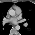 Anomalous right coronary artery (ARCA) with interarterial course (Radiopaedia 12423-12677 B 6).jpg