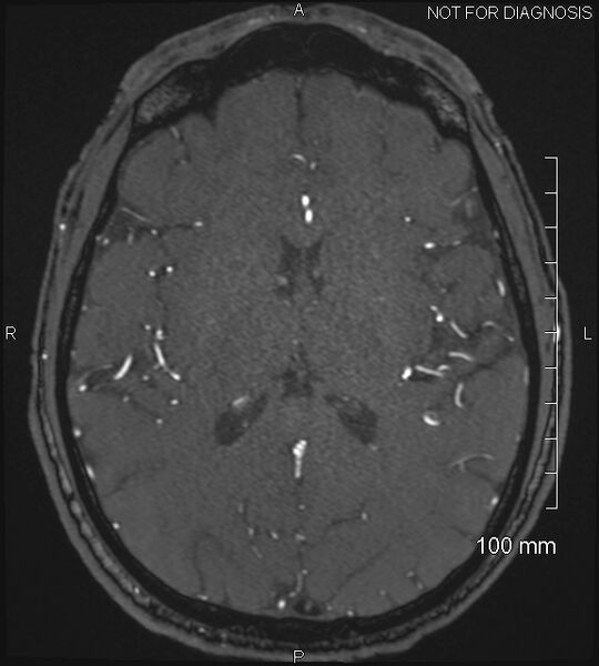 File:Anterior cerebral artery aneurysm (Radiopaedia 80683-94127 Axial MRA 139).jpg