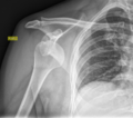 Anterior shoulder dislocation (Radiopaedia 82940).PNG