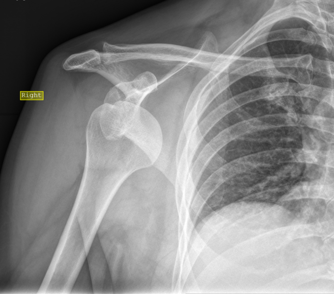 File:Anterior shoulder dislocation (Radiopaedia 82940).PNG
