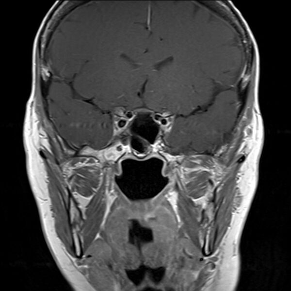 File:Anterior temporal encephalocele (Radiopaedia 82624-96808 Coronal T1 4).jpg