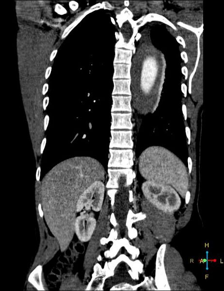 File:Aortic aneurysm and penetrating ulcer (Radiopaedia 23590-23704 B 22).jpg