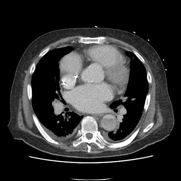 File:Aortic arch graft infection (FDG PET-CT) (Radiopaedia 71975-82437 A 32).jpg