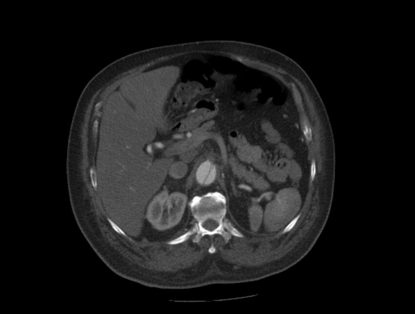 Aortic dissection (Radiopaedia 28802-29105 A 47).jpg