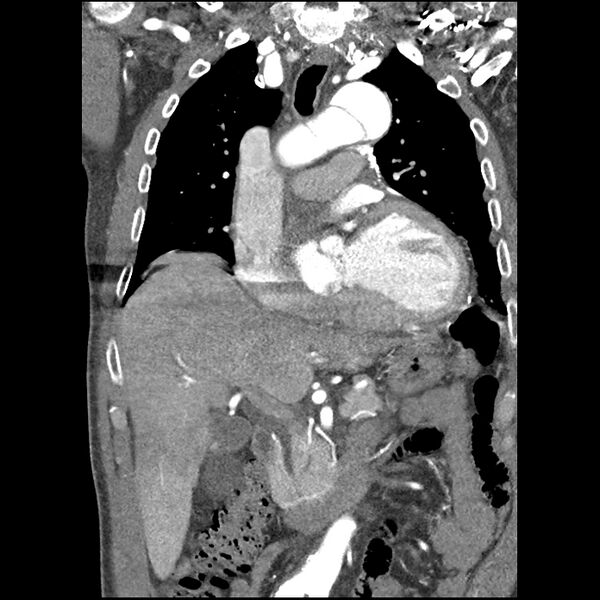 File:Aortic dissection - DeBakey Type I-Stanford A (Radiopaedia 79863-93115 B 16).jpg