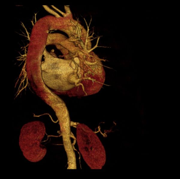 File:Aortic dissection with rupture into pericardium (Radiopaedia 12384-12647 D 16).jpg