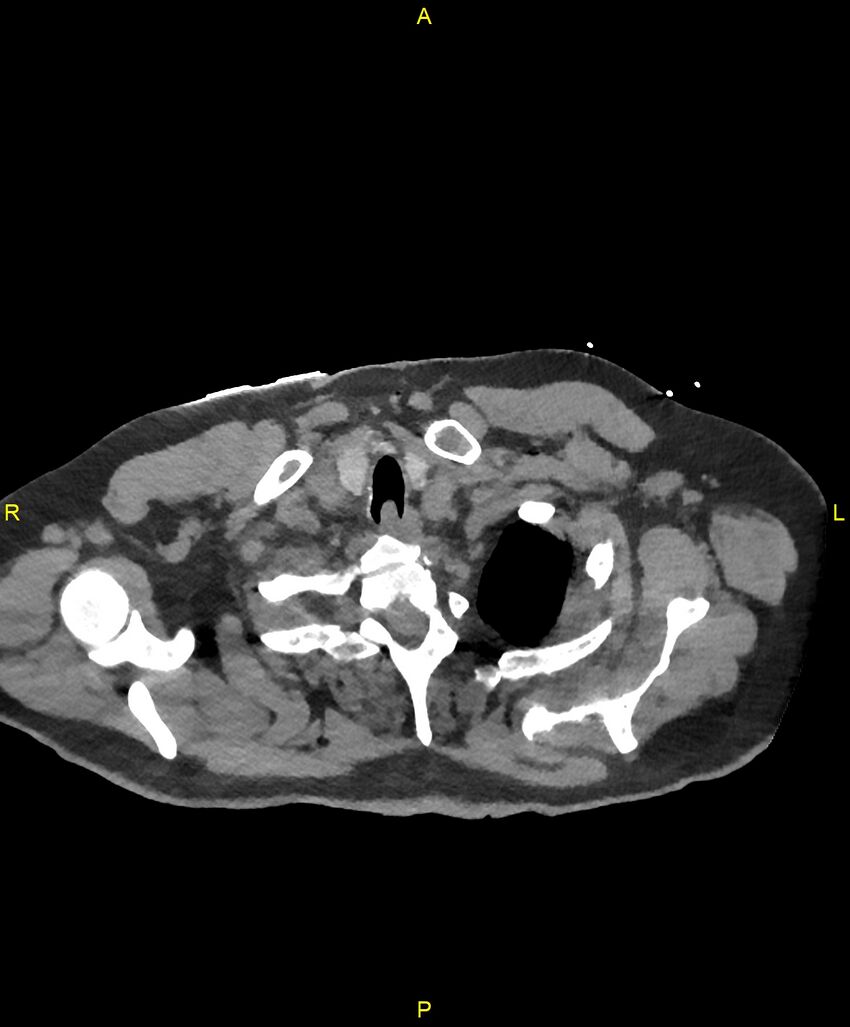 Aortic rupture (Radiopaedia 88822-105594 Axial non-contrast 10).jpg