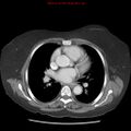 Aortic valve stenosis (Radiopaedia 14480-14423 C 1).jpg