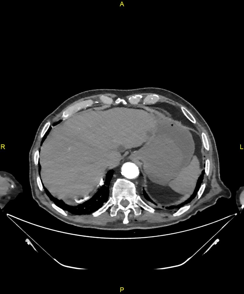 Aortoenteric fistula (Radiopaedia 84308-99603 B 37).jpg