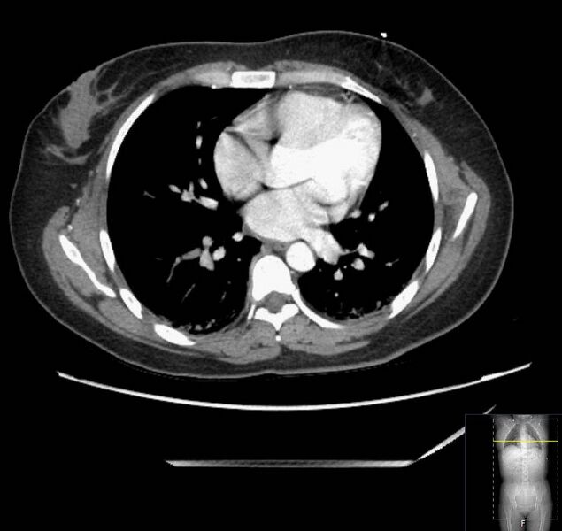 File:Appendicitis (CT angiogram) (Radiopaedia 154713-127660 Axial 194).jpg