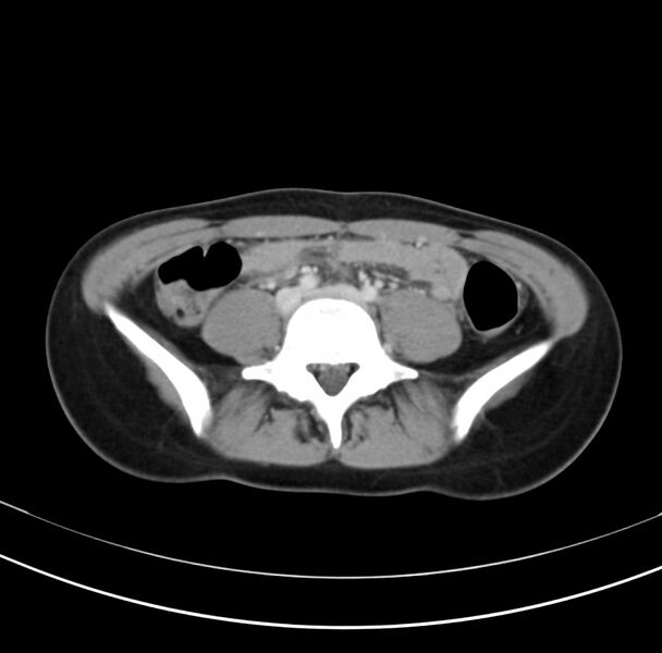 File:Appendicitis and incidental bicornuate uterus (Radiopaedia 22833-22853 B 29).jpg