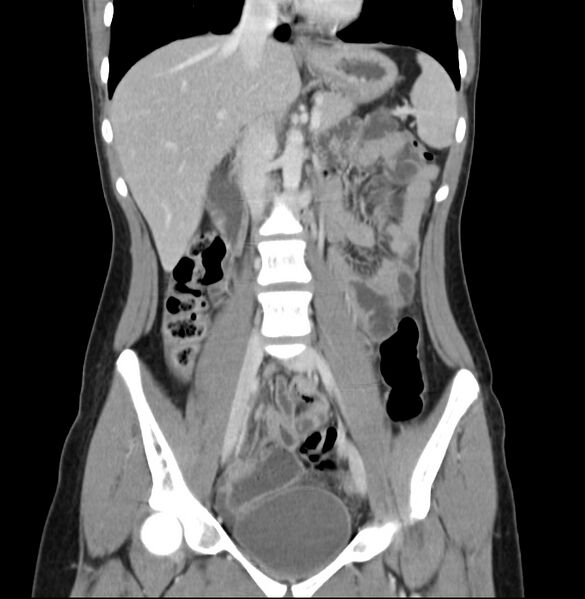 File:Appendicitis and incidental bicornuate uterus (Radiopaedia 22833-22853 D 19).jpg