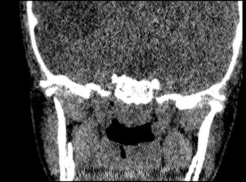 File:Arachnoid cyst- extremely large (Radiopaedia 68741-78450 Coronal bone window 2).jpg