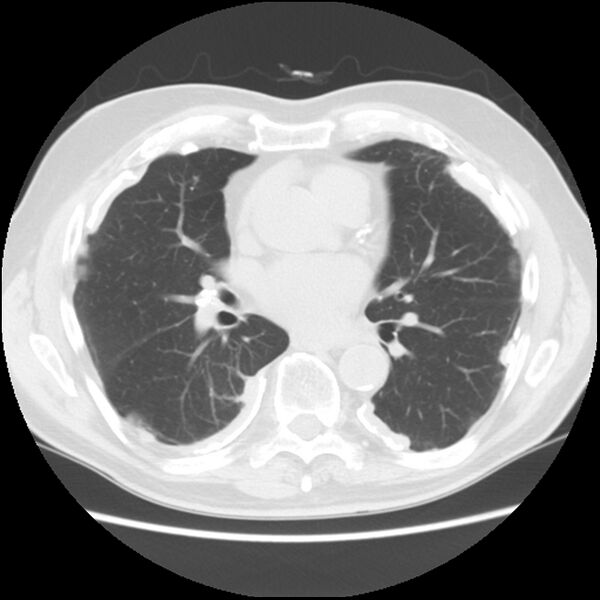 File:Asbestos-related pleural plaques (Radiopaedia 39069-41255 Axial lung window 40).jpg