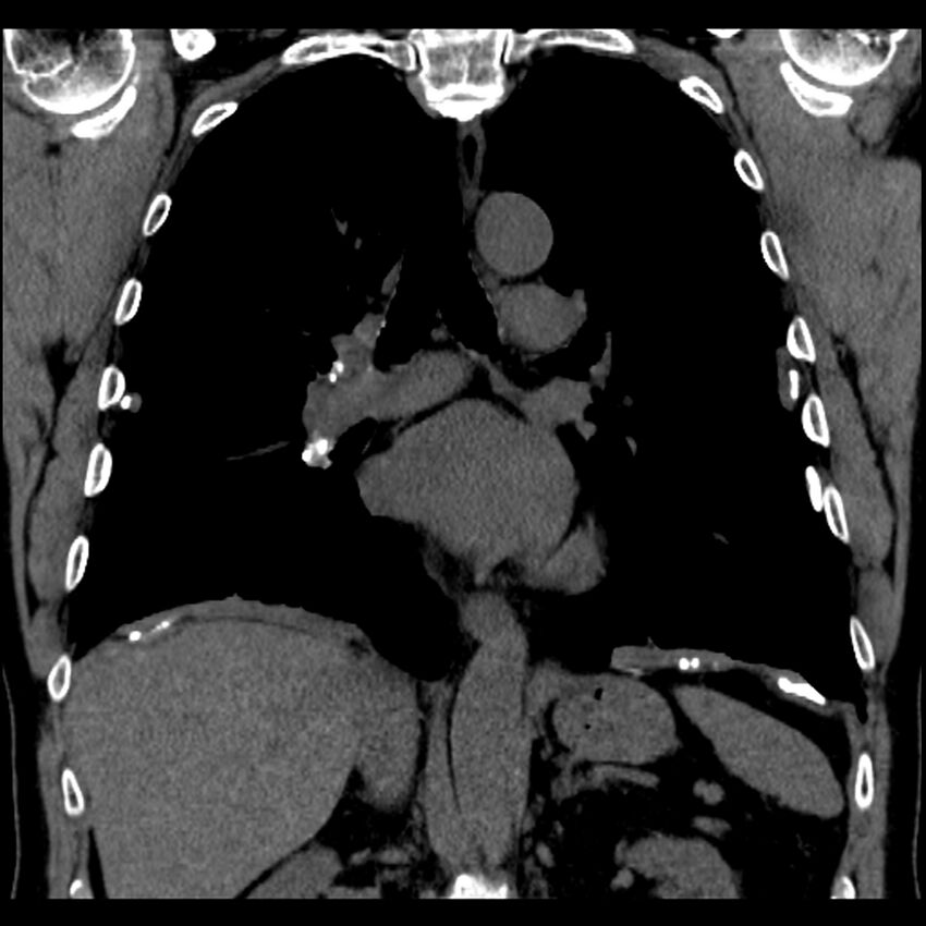 Asbestos-related pleural plaques (Radiopaedia 39069-41255 Coronal non-contrast 40).jpg