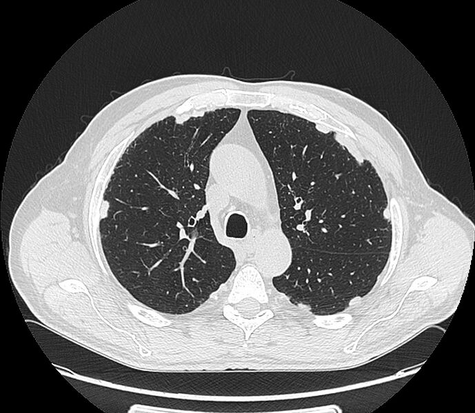 File:Asbestos pleural placques (Radiopaedia 57905-64872 Axial lung window 88).jpg