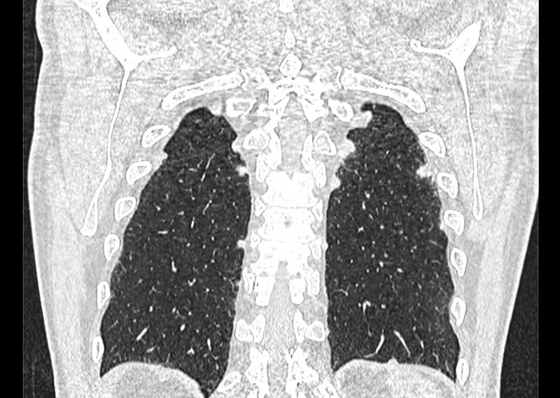 File:Asbestos pleural placques (Radiopaedia 57905-64872 Coronal lung window 247).jpg