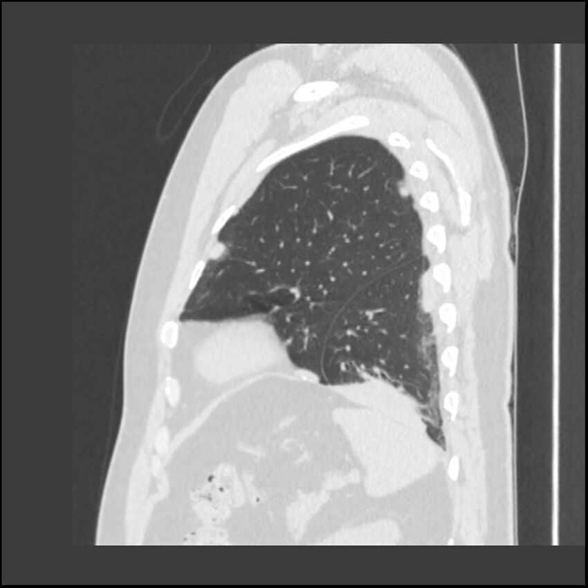 Asbestosis (Radiopaedia 45002-48961 Sagittal lung window 27).jpg