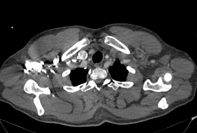 File:Ascending aortic aneurysm (Radiopaedia 86279-102297 C 3).jpg