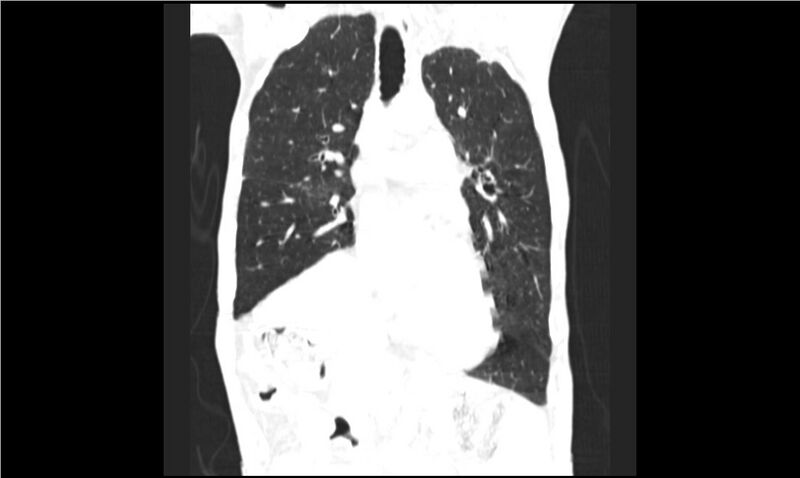 File:Aspergilloma (Radiopaedia 20788-20701 Coronal lung window 7).jpg