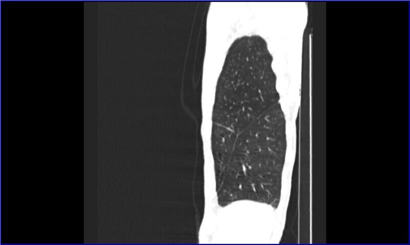 File:Aspergilloma (Radiopaedia 20788-20701 Sagittal lung window 1).jpg