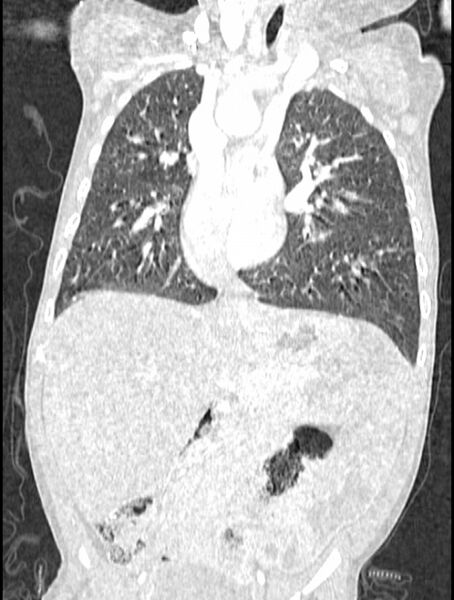 File:Asplenia syndrome (Radiopaedia 73083-83792 Coronal lung window 69).jpg